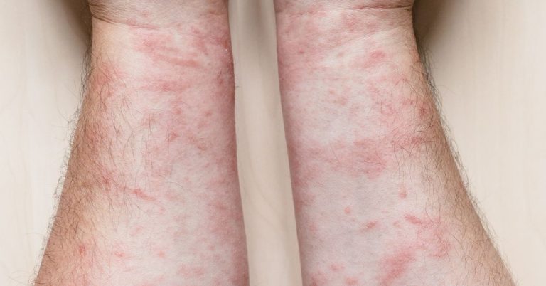 How long does fiberglass rash last - craftingwithconcrete.com